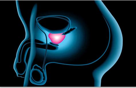 Pacientes con cáncer de próstata mejoran supervivencia con ...