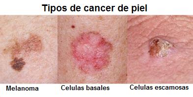Pacientex: Cancer de piel
