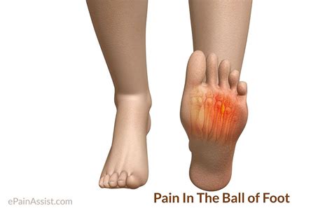 Pain In The Ball of Foot: Treatment, Causes, Symptoms ...