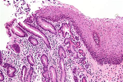Pancreatic acinar metaplasia Wikipedia