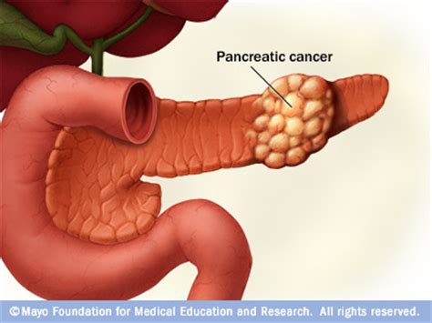 Pancreatic cancer Disease Reference Guide   Drugs.com