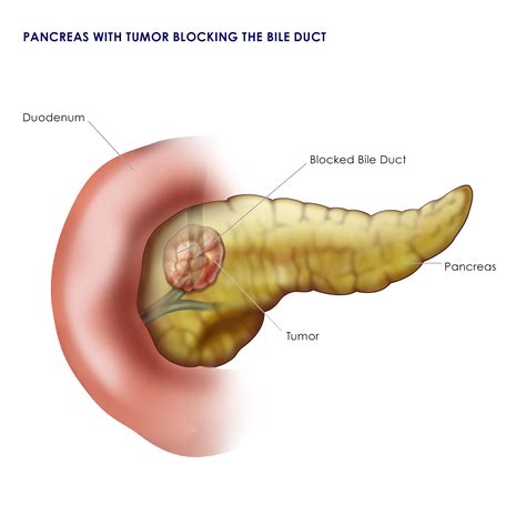 Pancreatic Cancer Surgery | Navigate Pancreatic Cancer