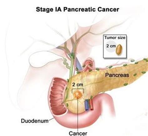 Pancreatic cancer Symptoms, Signs and Treatment | Science ...