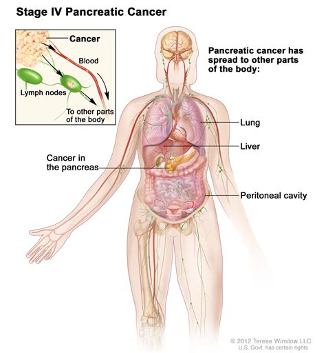 Pancreatic Cancer Treatment  PDQ  | Cure Today