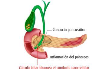 Pancreatitis Causas, síntomas y tratamiento