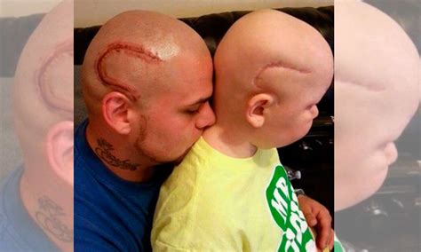 Papá se tatúa en la cabeza cicatriz de su hijo para ...
