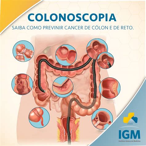 Papel da colonoscopia na prevenção do câncer de cólon e ...