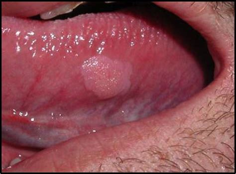 Papiloma Escamoso: causas e tratamento   odontoBLOGia