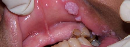 Papiloma humano bucal   virus del papiloma   Traducere în ...