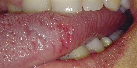 Papiloma oral, lesión exofítica de base sésil en margen lateral de ...