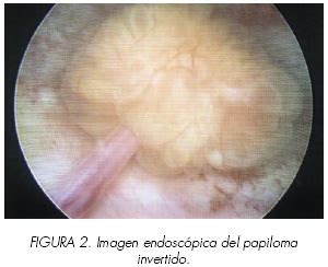Papiloma urotelial tratamiento. Posts navigation