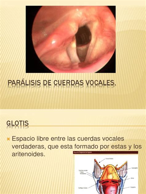 Paralisis de Cuerdas Vocales | Vagus Nerve | Human Anatomy
