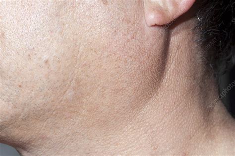 Parotid gland enlargement   Stock Image   C011/1730   Science Photo Library