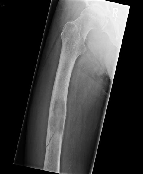 Pathological fracture of the femoral shaft due to lung ...