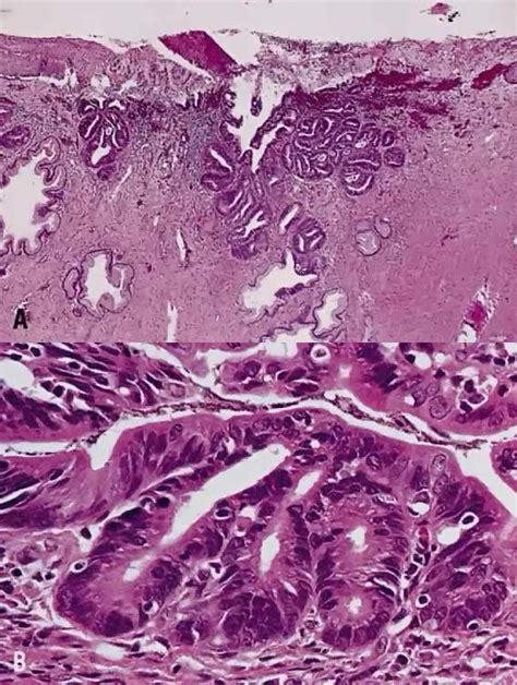 Pathology Atlas: Cervix | GLOWM