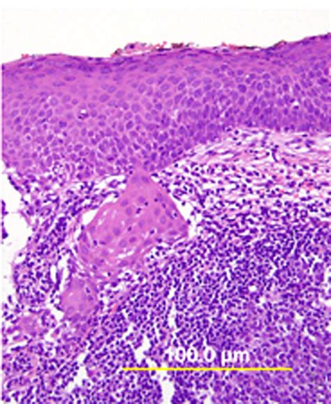 Pathology of Cervical Carcinoma | GLOWM