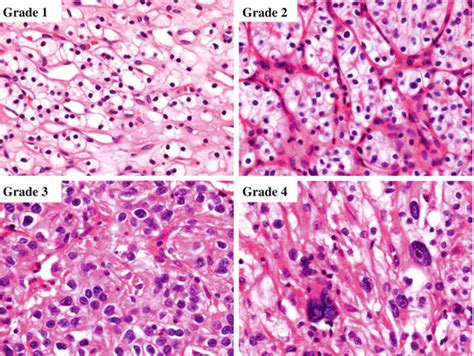 Pathology of Renal Cell Carcinoma | Oncohema Key