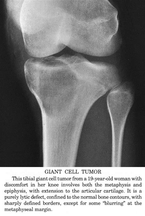 Pathology Outlines   Giant cell tumor of bone