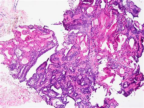 Pathology Outlines   Intraductal papilloma