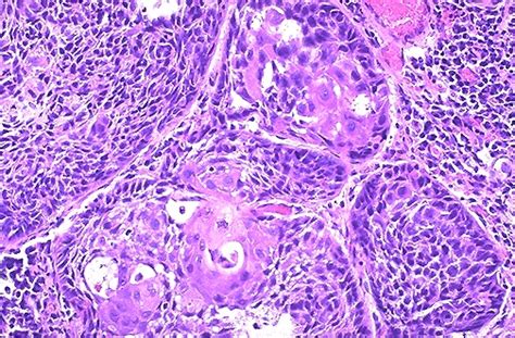 Pathology Outlines   Squamous cell carcinoma   general