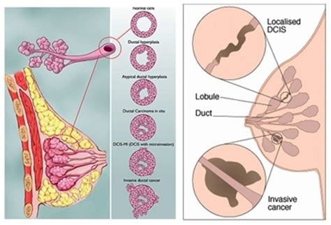 Pathology Report | Pathologist Melbourne | Breast Cancer ...