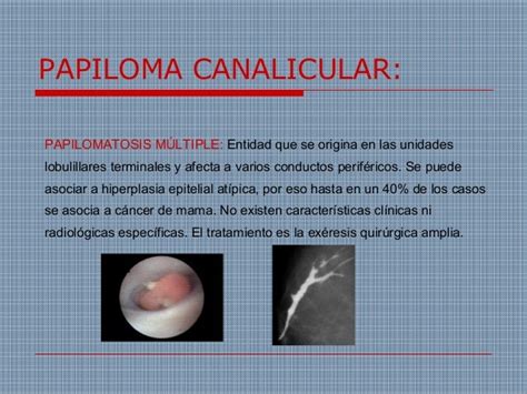 Patologia benigna de la mama. Dra. A. Moreno  www.oncocir.com
