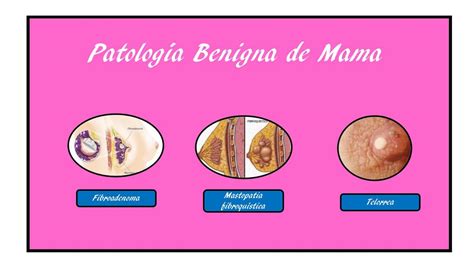 PATOLOGÍA BENIGNA DE MAMA infografia | Tumores benignos | Glándula ...