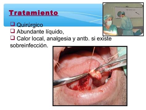 Patologia de boca y glandulas salivales