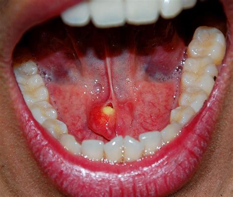 PATOLOGÍA de las glándulas salivales | Directorio Odontológico