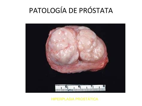 Patología de próstata.