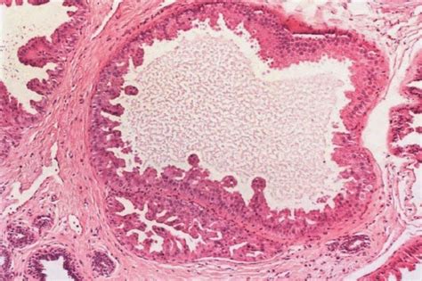 PATOLOGÍA HUMANA: Lesiones epiteliales benignas de la mama femenina
