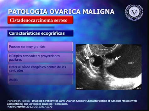 Patologia maligna de ovario