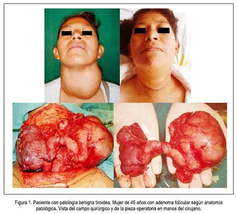 Patología quirúrgica de la glándula tiroides