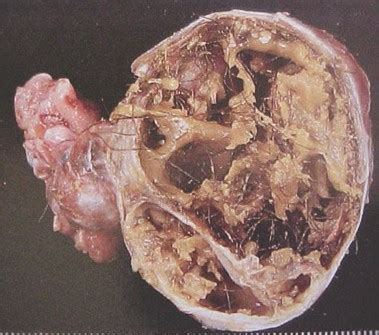 Patología: Teratoma inmaduro maligno de ovario