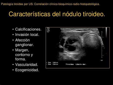 Patología tiroidea por ultrasonido