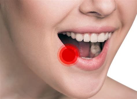 PATOLOGÍA : Tumores benignos de la mucosa oral | Directorio Odontológico