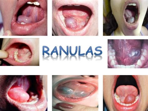 Patologias de glandulas salivales