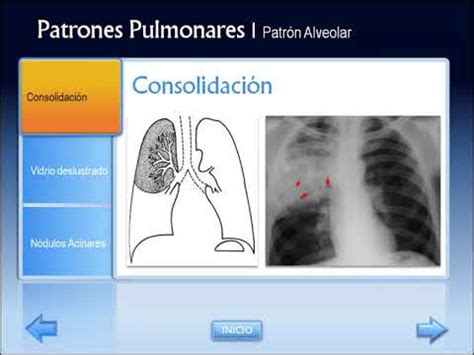 Patrones Pulmonares en Radiología y TC   YouTube