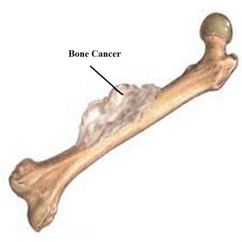 Pay Attention on Bone Cancer Symptoms   Types of Cancer