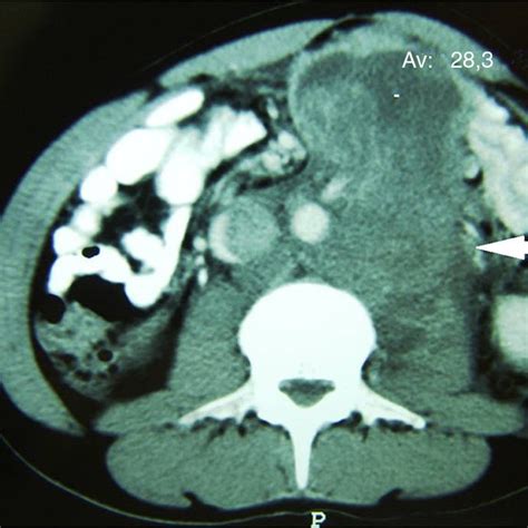 PDF  Bilateral and synchronous testicular teratoma: A case report and ...