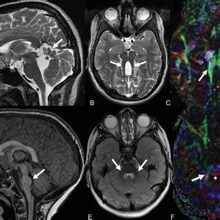 PDF  Congenital Brain Abnormalities: An Update on ...