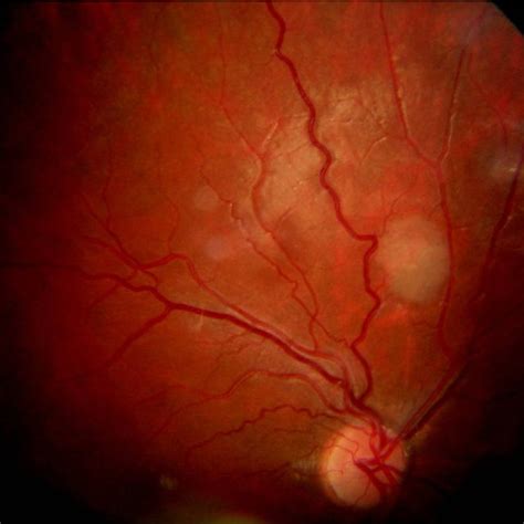 PDF  Hamartoma astrocítico retiniano: manifestación ocular de ...