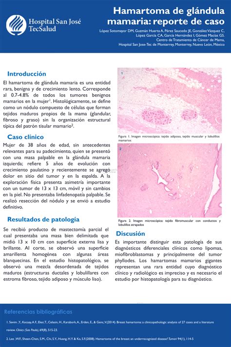PDF  Hamartoma de glándula mamaria: reporte de caso