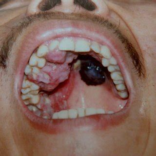 PDF  Malignant melanoma of the oral cavity. Review of the ...