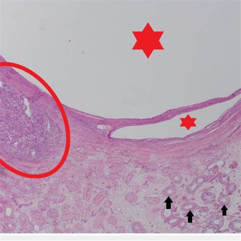 PDF  Mature Testicular Teratoma with a Focus of Embryonal Carcinoma: A ...
