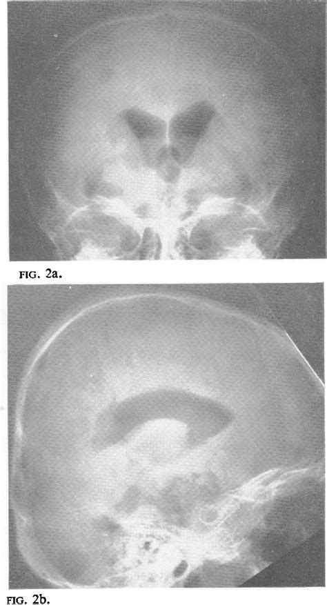 [PDF] Pubertas praecox due to hypothalamic hamartoma: report of two ...