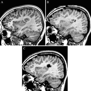 PDF  Resective surgery for focal cortical dysplasia in ...