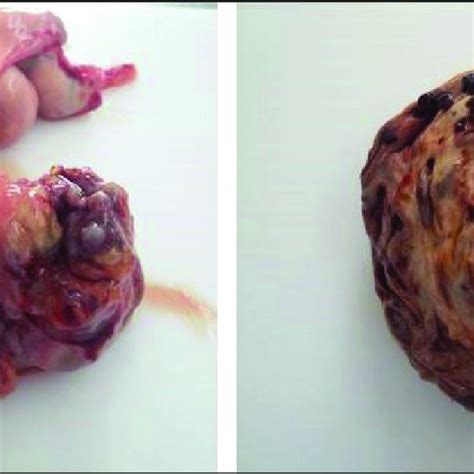 PDF  Testicular Teratoma in a Unilateral Right Sided Abdominal ...