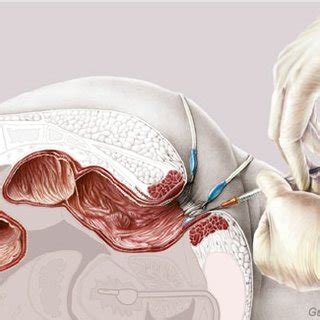PDF  The ileo neo rectal anastomosis: Long term results ...