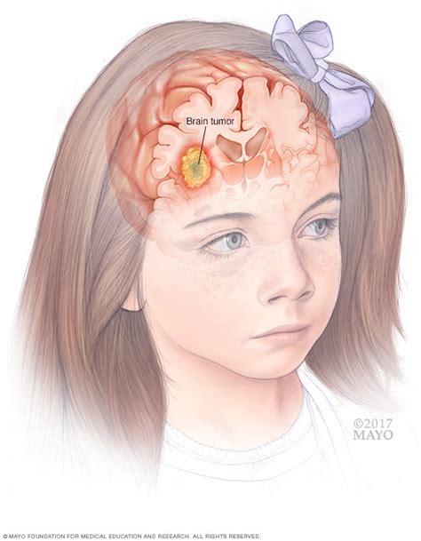 Pediatric brain tumors   Symptoms and causes   Mayo Clinic